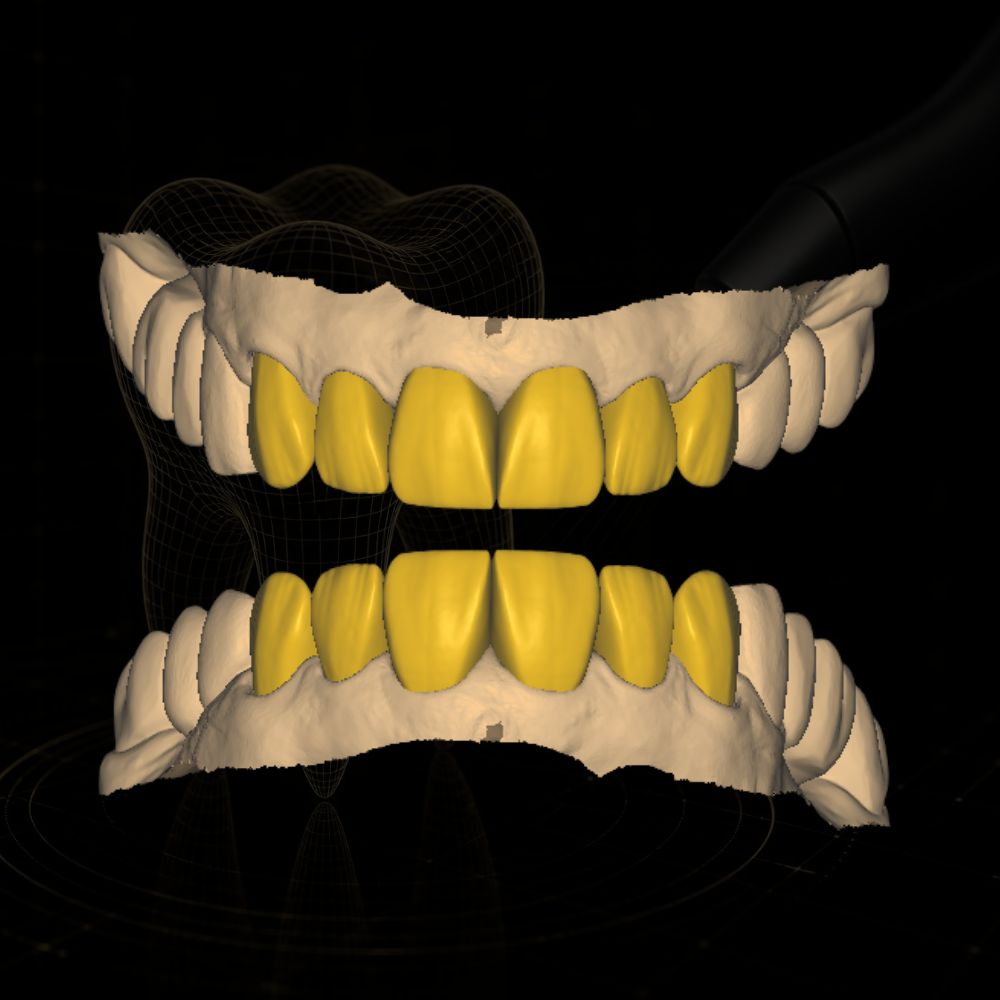 Caso de design CAD/CAM dental realizado pela Chase Cad