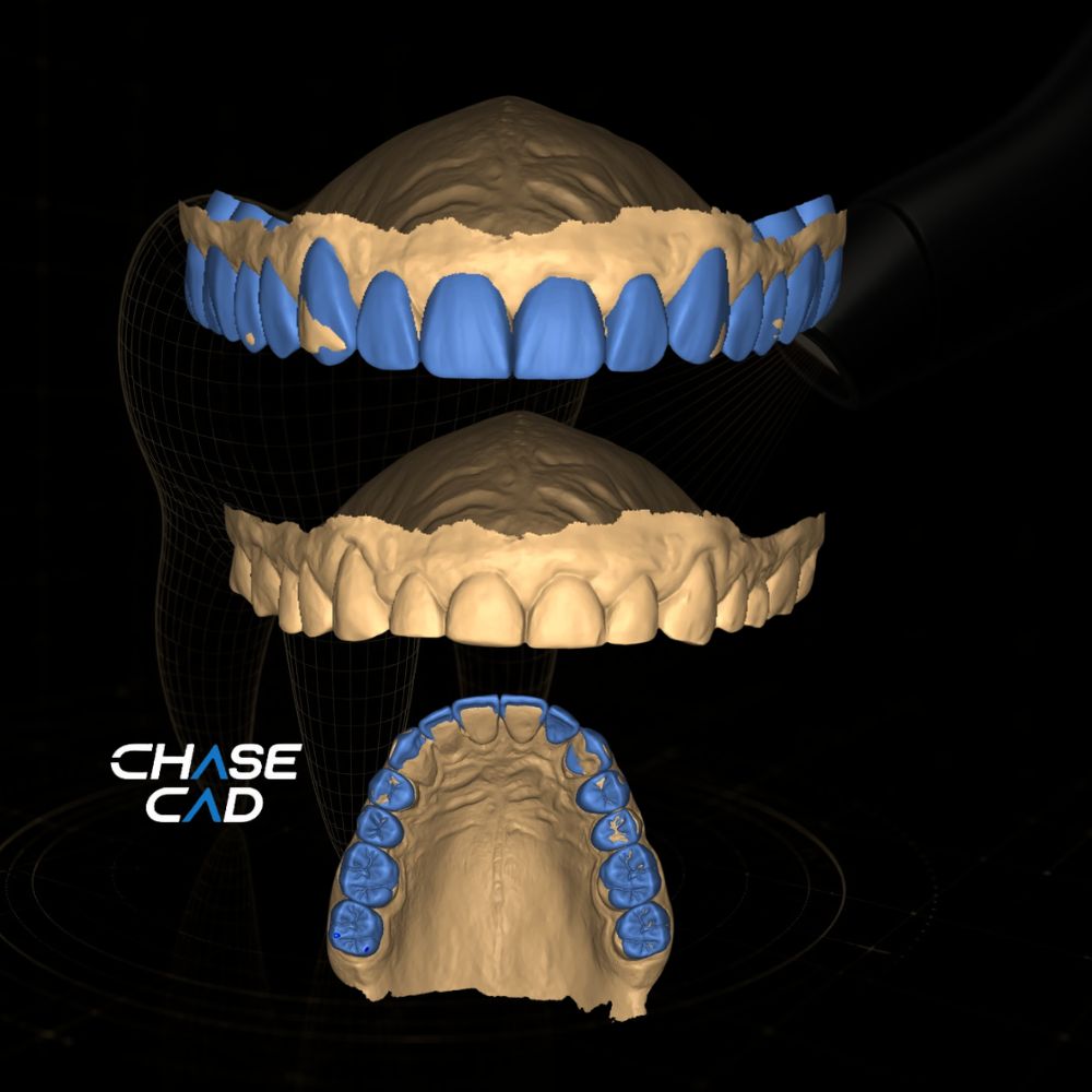Caso de design CAD/CAM dental realizado pela Chase Cad